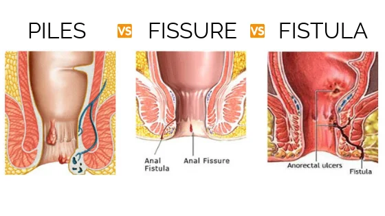 difference between fissures and piles